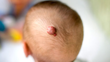 emangioma-nuovo-studio-nutraceutica